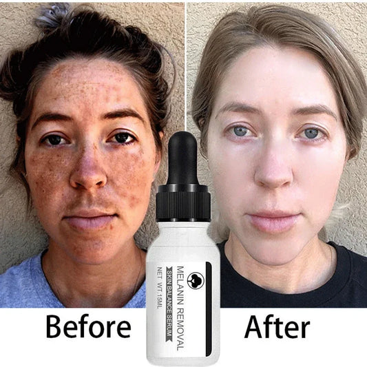 Niacinamide Serum Remove Dark Spots Whitening Moisture Powerful Removal Melasma Chloasma Black Freckle Face Skin Care Cream